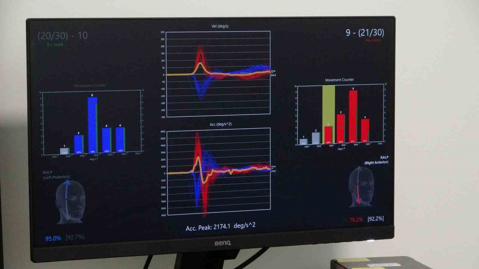 Malatya vertigo tedavisinde bölgenin referans noktası
