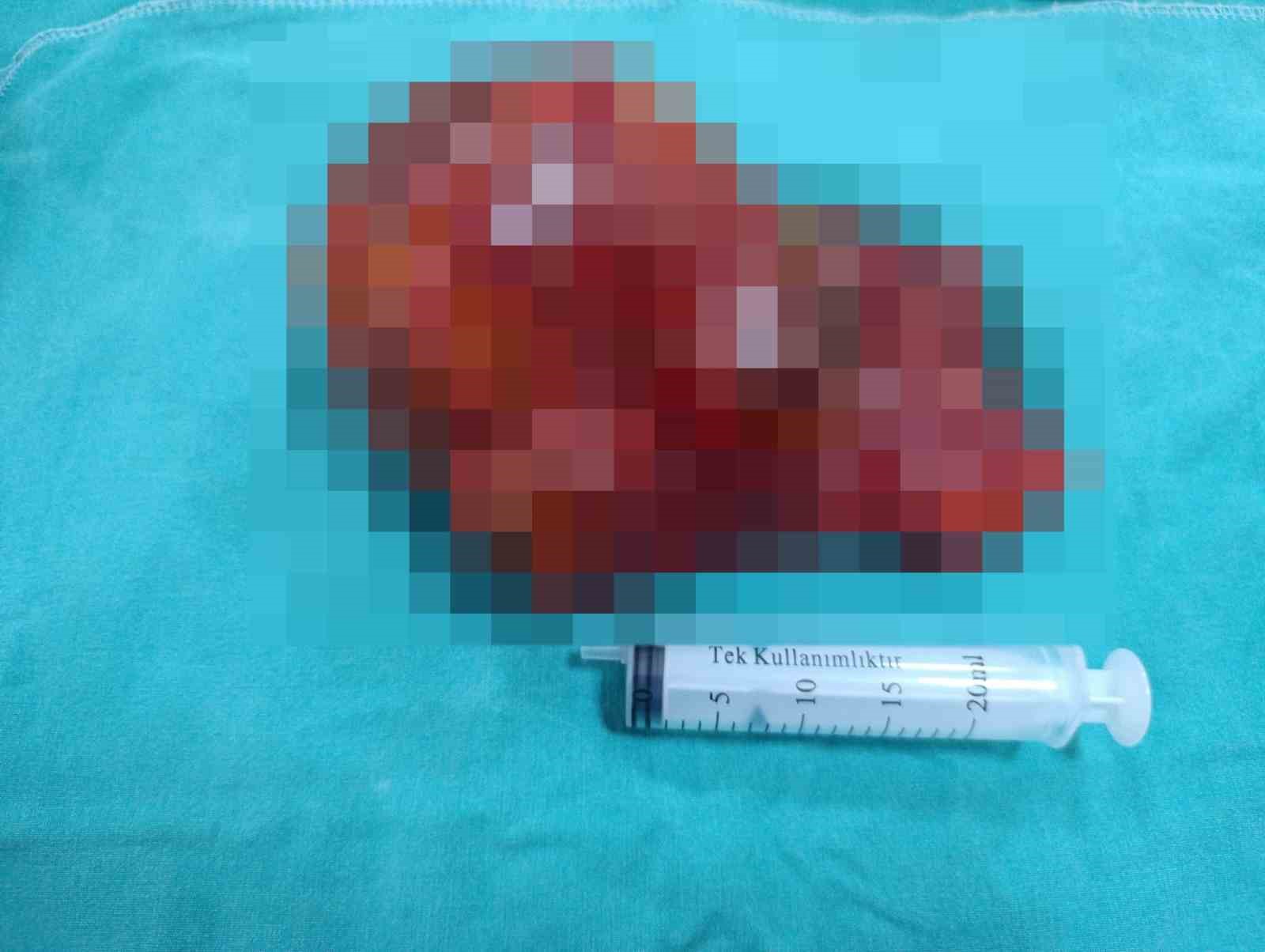 Malatya’da 20 santimetrelik kitle kapalı yöntemle çıkarıldı
Malatya’da 20 santimetrelik kitle kapalı yöntemle çıkarıldı