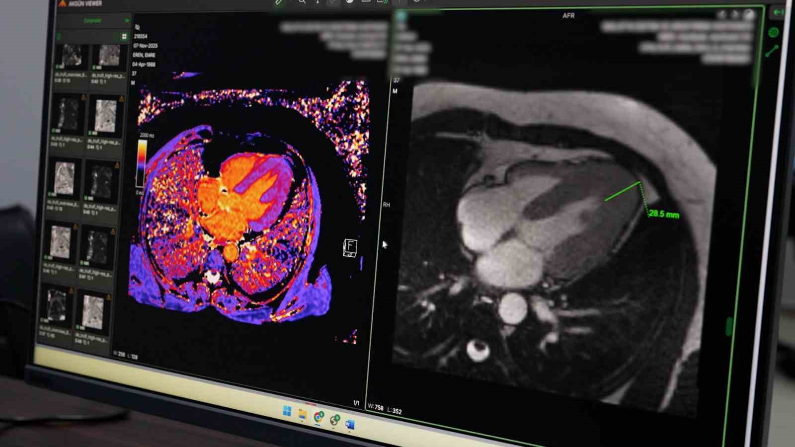 Malatya’da ileri radyolojik tetkiklerle tanı ve tedavi dönemi
