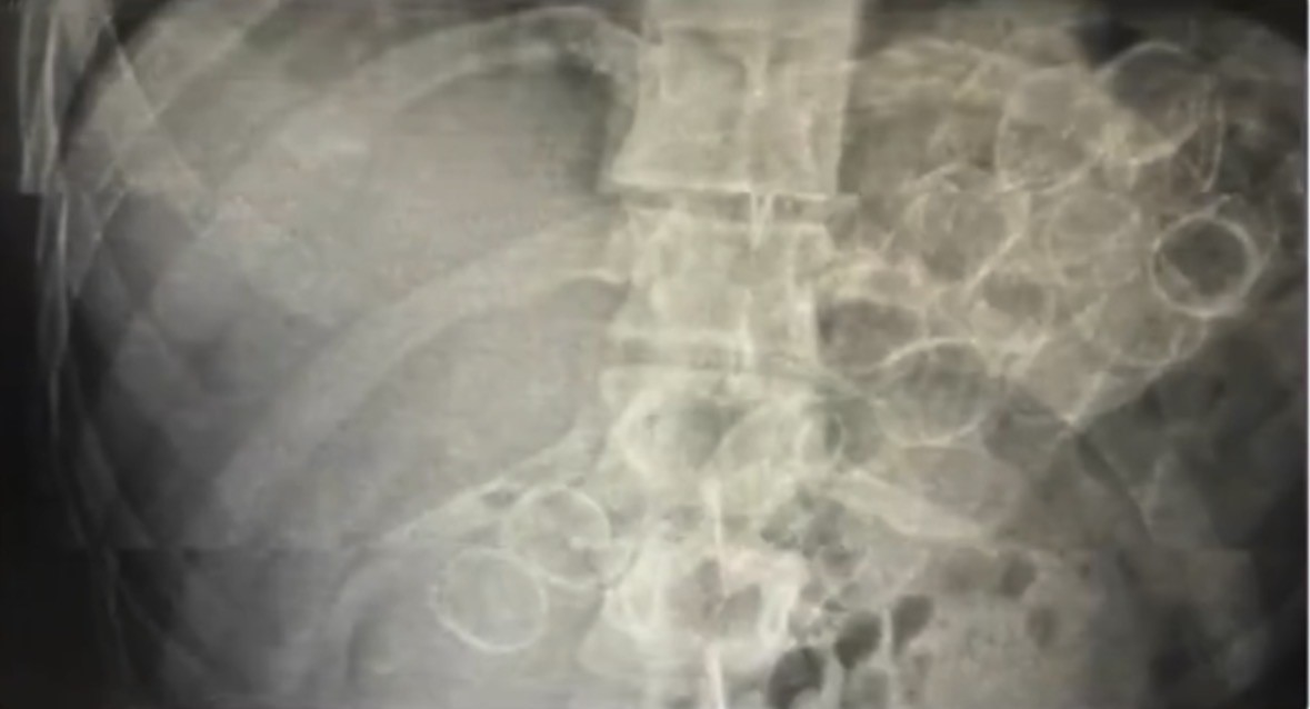 Mide ve bağırsaklarında uyuşturucu ele geçirilen 3 şüpheli tutuklandı
