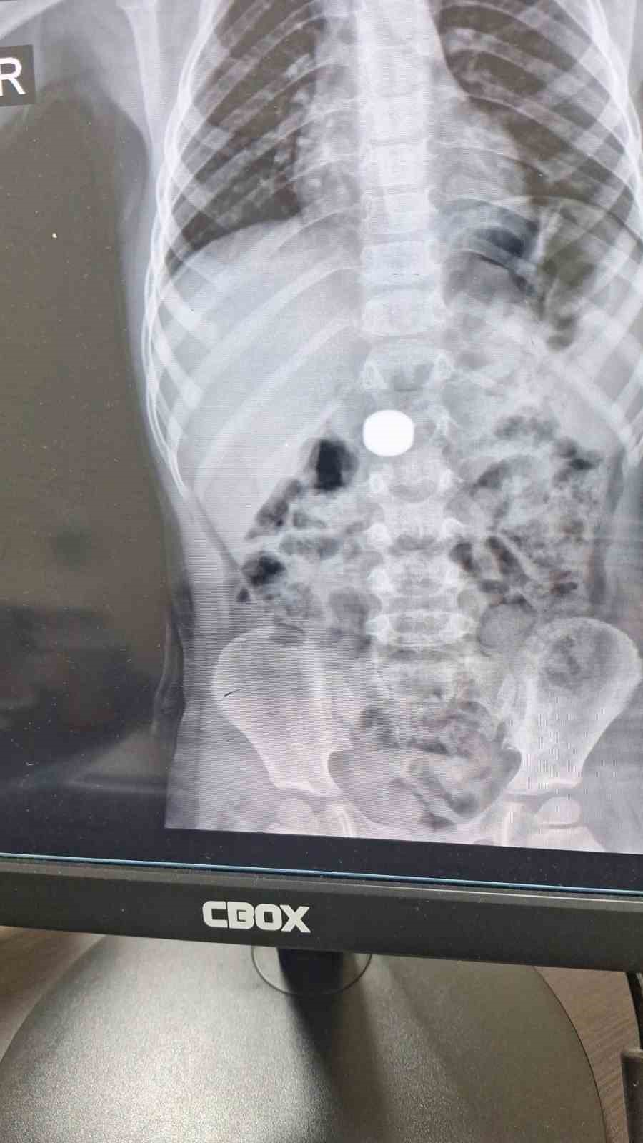 Mıknatıs yutan çocuk, ameliyatla sağlığına kavuştu
