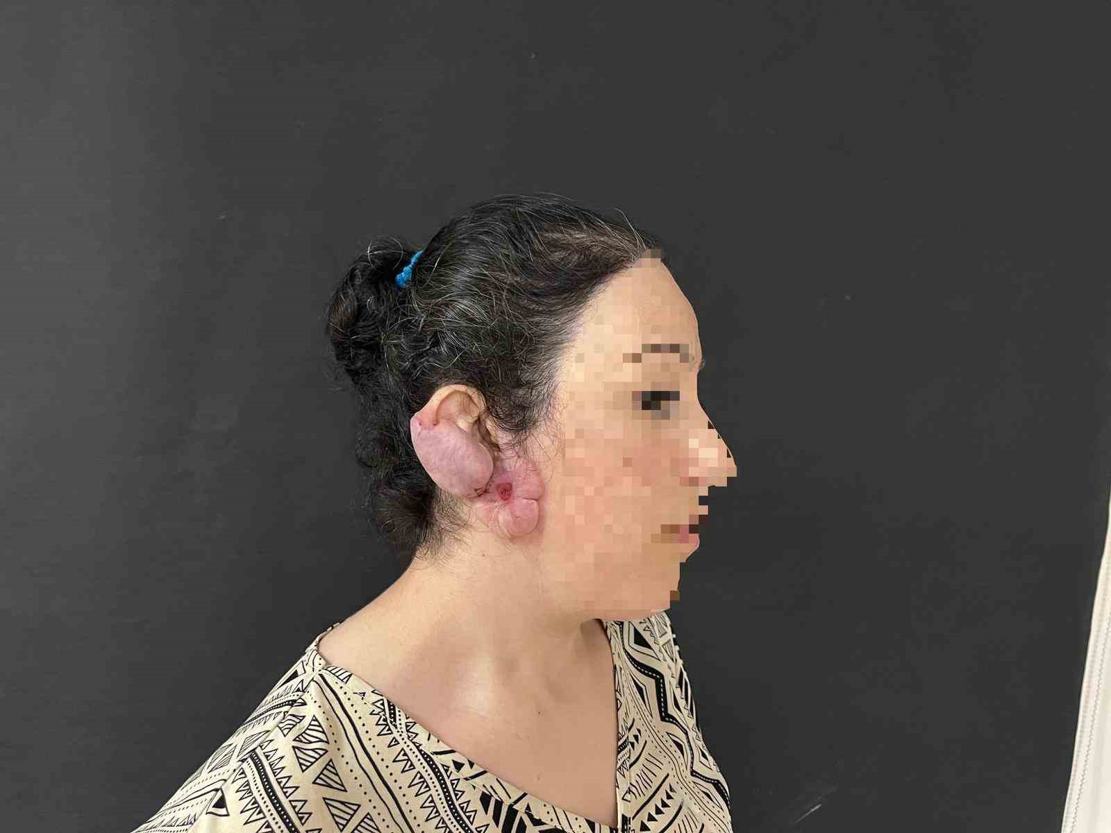 Muş’ta bir ilk: Kulak keloidi, ödüllü cerrahi teknikle tedavi edildi
Muş’ta bir ilk: Kulak keloidi, ödüllü cerrahi teknikle tedavi edildi