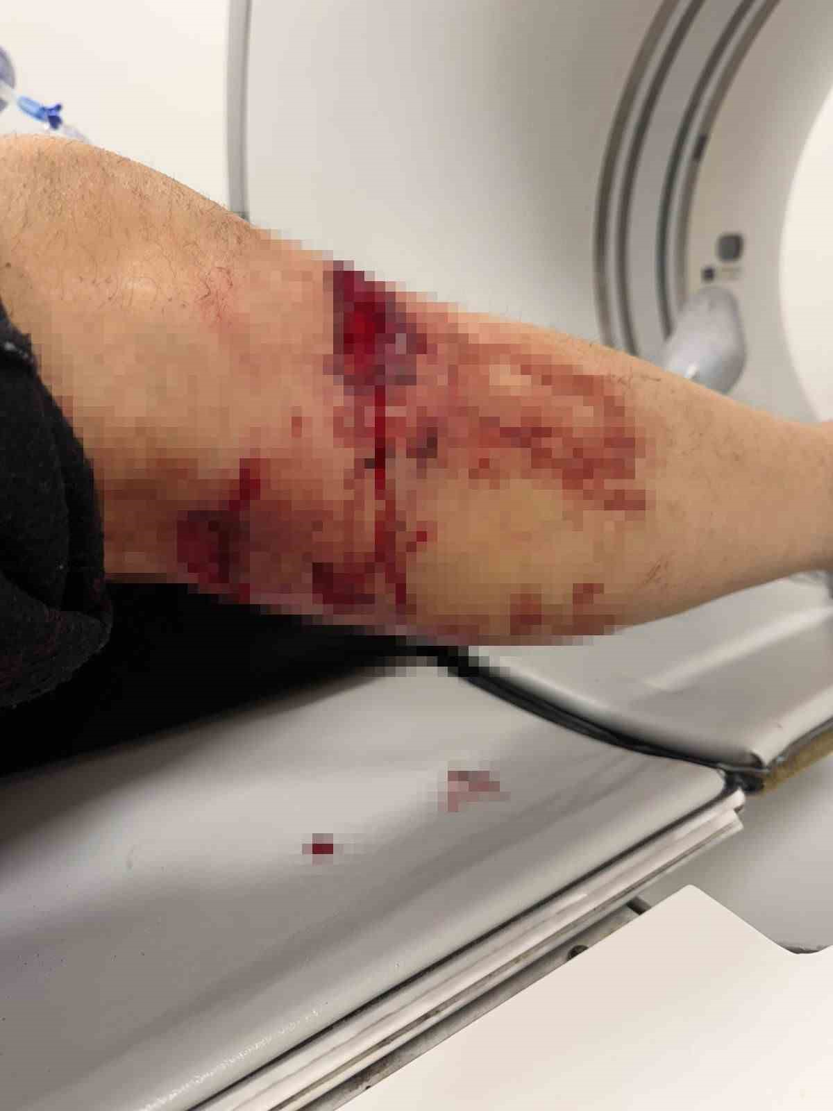 Nizip’te başıboş köpek saldırısında yaralanan 2 kişi belediyeye tepki gösterdi
