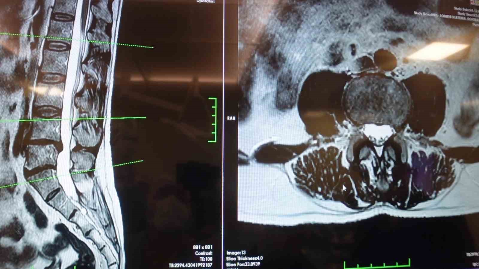 Prof. Dr. Erol: "Bel ağrılarının büyük kısmı bel fıtığından değil, mekanik bel ağrısından kaynaklıdır"
