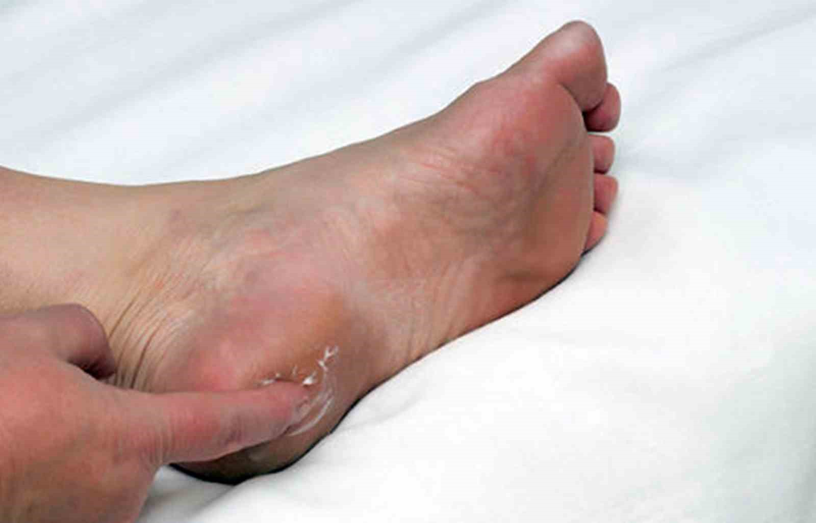 Prof. Dr. Karalezli’den topuk dikeni uyarısı: "Çözüm dikeni kırmak değil"
