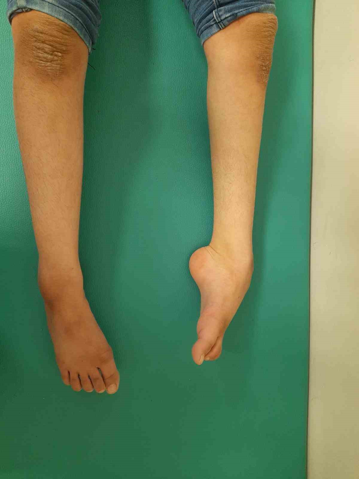 Şanlıurfa’da yatağa bağlı kardeşler tedavi sonrası yürümeye başladı
