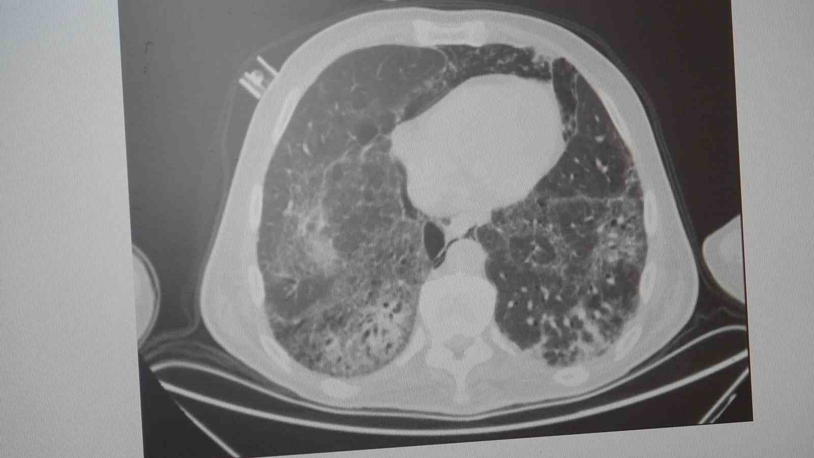 Uzmanından dünyada en çok öldüren 4’üncü hastalık için uyarı: "KOAH’ı sigarayı bırakmak, zatürreyi aşı durdurur"
