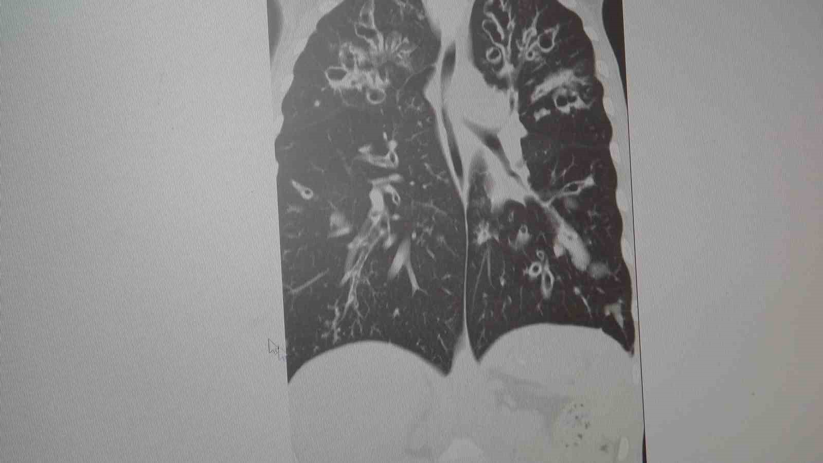 Uzmanından dünyada en çok öldüren 4’üncü hastalık için uyarı: "KOAH’ı sigarayı bırakmak, zatürreyi aşı durdurur"
