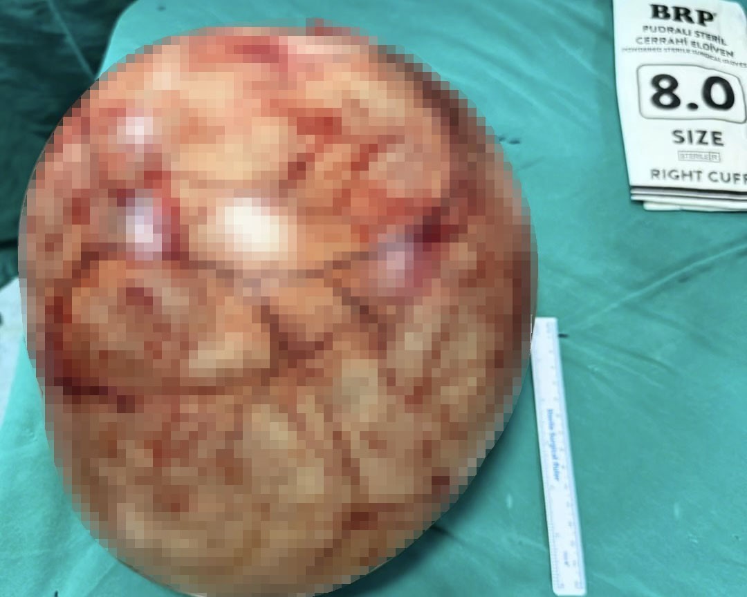 Van’da bir kadının karnından 35 santimetrelik dev kitle çıkarıldı
