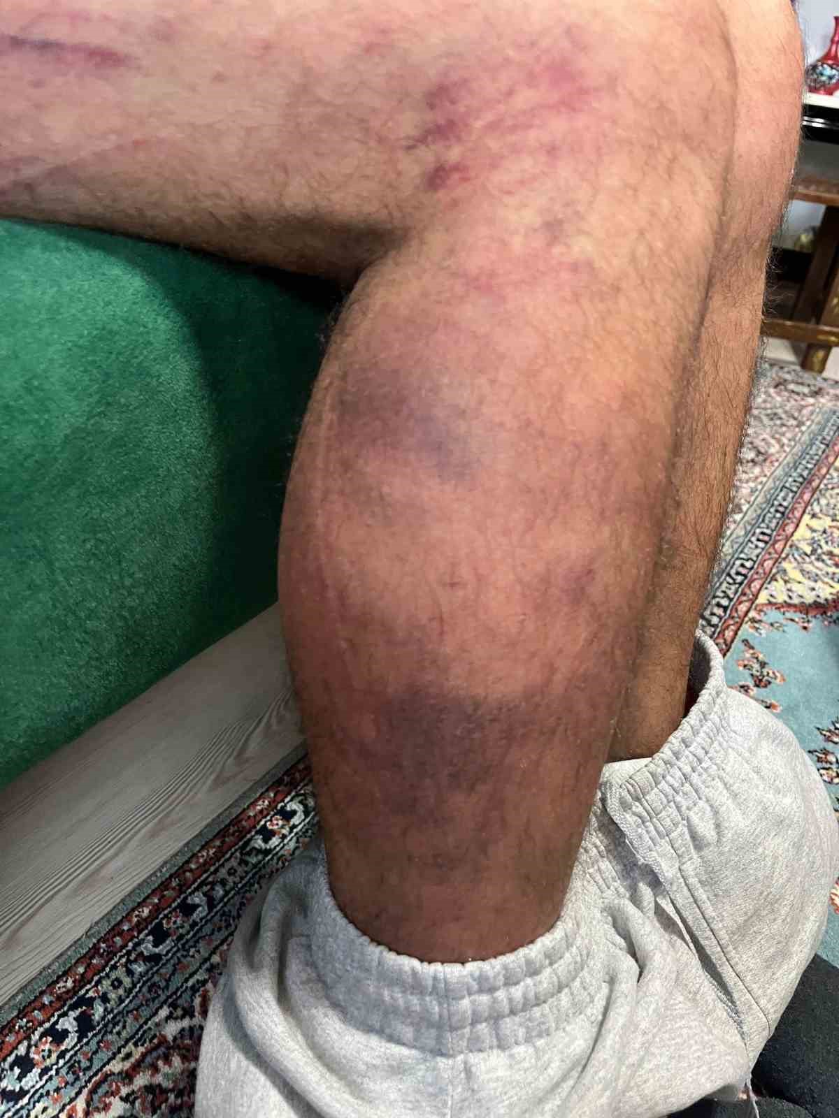 Yüzde 84 engeli bulunan adamı 30 dakika boyunca döven sanığın cezası belli oldu
