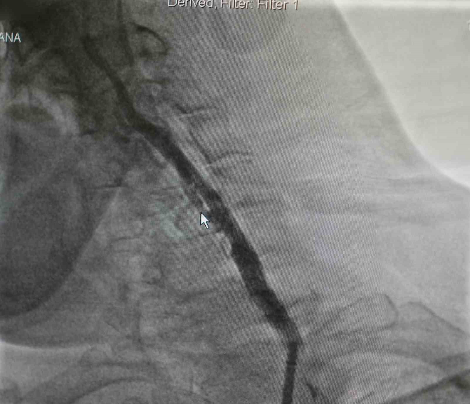 Yüzde 90 tıkalı boyun damarına kritik müdahale: Felç riski önlendi

