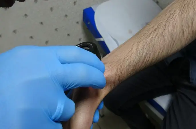 Uyuz hastalığı covid-19 ile tetiklendi