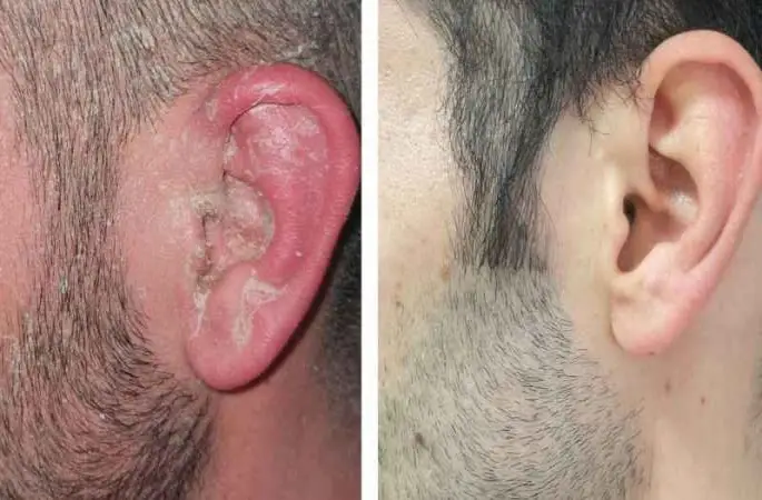 Sedef hastalığının tedavisi kolay