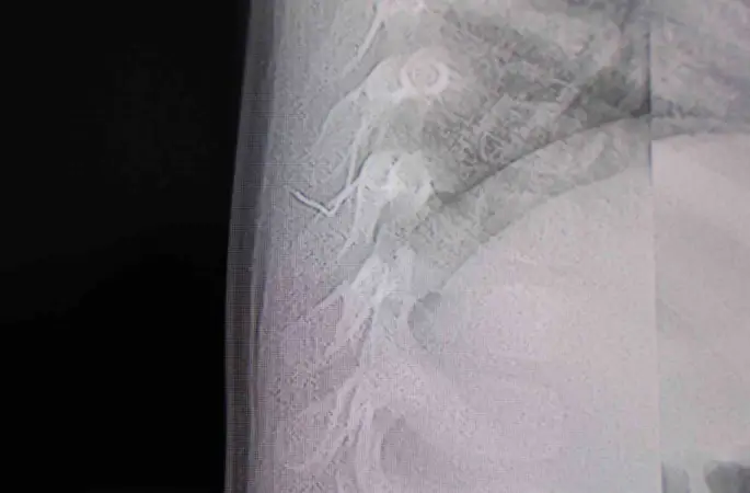 Bebeğin sırtından tel parçası çıktı
