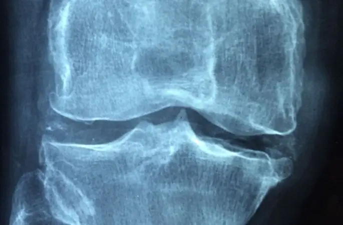 Kemik kırıkları kök hücre ile iyileştiriliyor